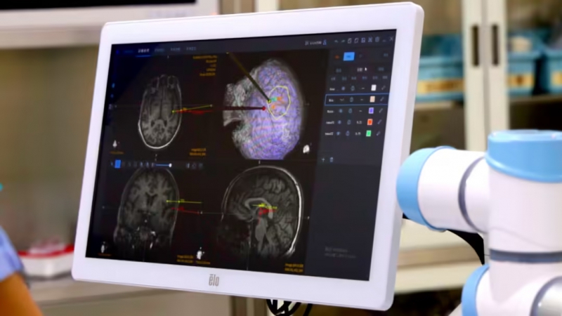 全球首例！我国无线植入式脑机接口让渐冻症患者重获“语言新生”(图1)